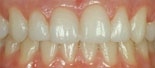 Dentala_anomalier_efter