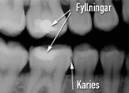 karies7