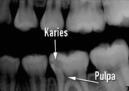 karies8